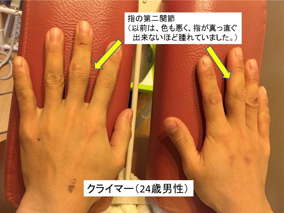 指 曲げる と 痛い 第 三 関節